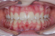 Stěsnání a protruze (předkus): extrakce (vytržení) dvou zubů v horním zubním oblouku