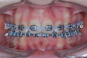 Stěsnání a protruze (předkus): extrakce (vytržení) dvou zubů v horním zubním oblouku