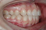 Neextrakční terapie (zařazení špičáků do oblouku bez trhání zubů)