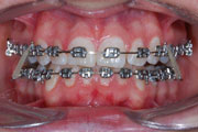 Neextrakční terapie (nivelizace – vyrovnání oblouku bez trhání zubů)