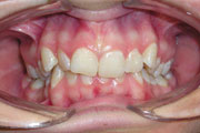 Neextrakční terapie (nivelizace – vyrovnání oblouku bez trhání zubů)