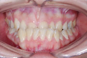 Obrácený skus, kombinovaná ortodonticko chirurgická terapie