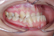 Obrácený skus, kombinovaná ortodonticko chirurgická terapie