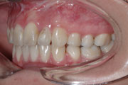 Otevřený skus, kombinovaná ortodonticko chirurgická terapie