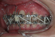 Otevřený skus, kombinovaná ortodonticko chirurgická terapie